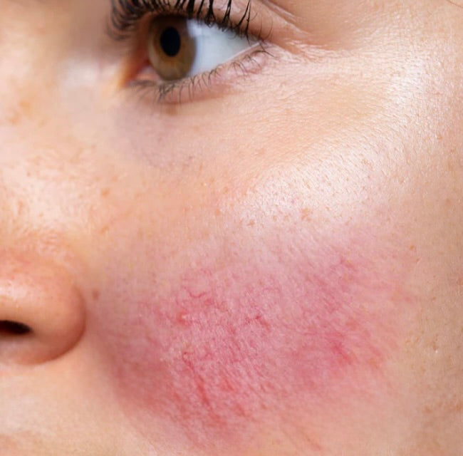 QMS Oplossingen voor de Gevoelige Huid